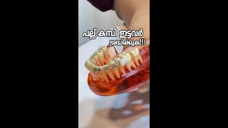 പല്ല് കമ്പി ഇട്ടവർ ശ്രദ്ധിക്കുക dentalbraces aftercare dentalexperience [upl. by Seravat427]