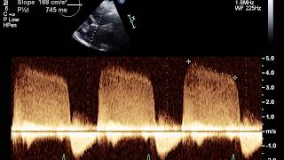 Echocardiogram With Mild Aortic Insufficiency [upl. by Nohsal]