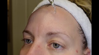 Daily Skincare Routine for PCOS  Using Tretinoin amp Electrolysis hair removal  skincare in your 30s [upl. by Eisdnyl]