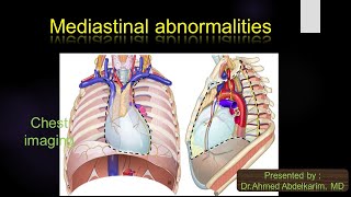 The cervicothoracic sign can help you locate superior mediastinal masses [upl. by Lilak]