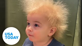 Uncombable hair syndrome Babys ultrarare follicle genes [upl. by Erolyat418]