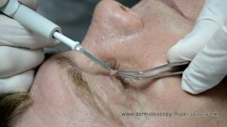 Soft fibroma  removal by highfrequency electrosurgery [upl. by Akerdna432]