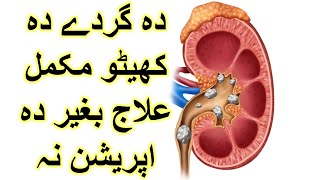 kidney stones complete treatment with homeopathic medicine [upl. by Anceline]