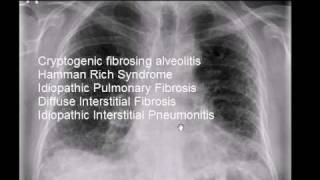 Chest xray idiopathic pulmonary fibrosis cryptogenic fibrosing alveolitis [upl. by Paderna635]