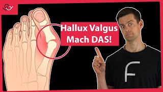 Hallux Valgus loswerden  Diesen Fehler macht jeder [upl. by Sikram814]