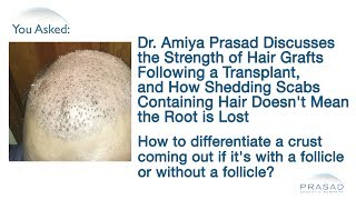 Why Dislodged Scabs Containing Hair After a Hair Transplant Doesnt Mean That Hair Grafts are Lost [upl. by Mariano]