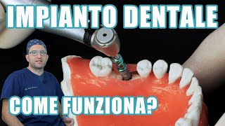 Impianto dentale fisso 13 [upl. by Eidahs]