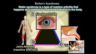 Reiters Syndrome Reactive Arthritis  Everything You Need To Know  Dr Nabil Ebraheim [upl. by Malas]