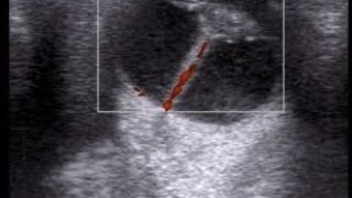 persistent hyperplastic primary vitreous on ultrasound [upl. by Adolfo]