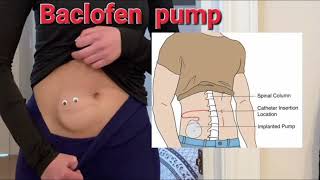 Baclofen pump mrcpch Communication [upl. by Adnorehs]