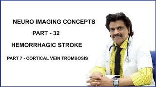 NEUROIMAGING PART32HEMORRHAGIC STROKEPART 7  CORTICAL VEIN TROMBOSIS [upl. by Cyn]