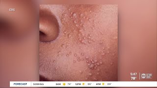 Local pediatrician advises parents on treating molluscum viral skin infection common with kids [upl. by Nerraw]