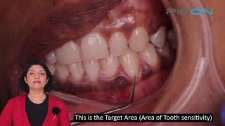 Treatment for Dentin Hypersensitivity using 980nm and 8mm tip [upl. by Otsedom]