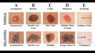 Melanoma Cancer Awareness  Understanding the hidden dangers of the deadliest of skin cancers [upl. by Machos]