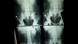 IVPIVU Intravenous UrographyPyelography BASICS OF RADIOGRAPH EXPLAINED [upl. by Yesnil654]