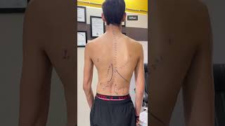 Different types of scoliosis treated byDrRavi scoliosistreatment chiropractic chiro spine short [upl. by Ahsoym]