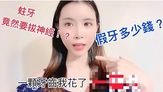 蛀牙要抽神經🦷做假牙竟然花了五位數‼️ [upl. by Lissie]