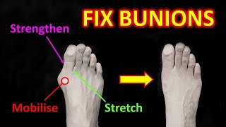 How do you get rid of bunions [upl. by Cima]