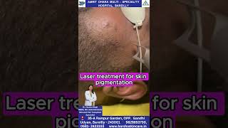 Laser treatment for skin pigmentation [upl. by Wyck896]