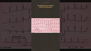 ECG Diagnosis [upl. by Cailean]