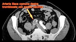 ARTERIOPATIE DEGENERATIVE ACQUISITE E FATTORI DI RISCHIO Serie Casi Clinici Multimediali n32023 [upl. by Hildegard]