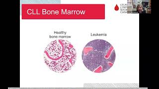 Chronic lymphocytic leukemia CLL What it is when to treat and what’s ahead [upl. by Nima]