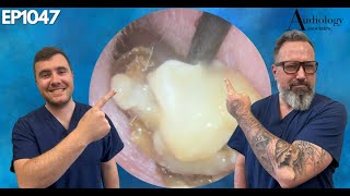 WET MASTOIDECTOMY EAR WAX REMOVAL  EP1047 [upl. by Labannah461]