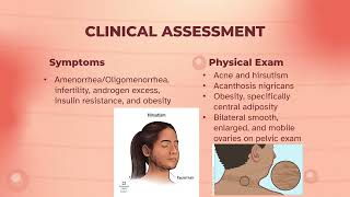 Polycystic Ovary Syndrome PCOS [upl. by Niret]