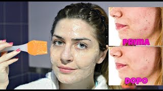 FUNZIONA MASCHERA viso semplice ANTI MACCHIE fatta in casa SOLO 4 ingredienti [upl. by Aihseuqal]