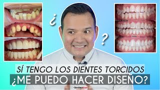 Tengo Los Dientes Torcidos 😬 ¿Me puedo hacer Diseño de Sonrisa 🦷 ¿Me Desgastan  Odontología Láser [upl. by Latsyrk449]