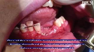 Vape pen explodes shattering teenagers jaw and knocking out some teeth [upl. by Reisman]