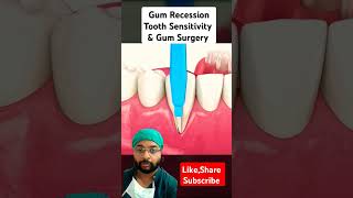 Gum Surgery Animationyt shorts gumsurgery gumrecession sensitivity dentalanimation3d [upl. by Ylloj]