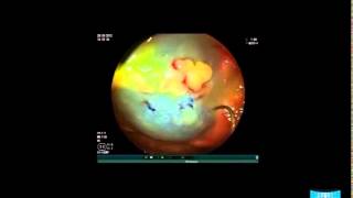 Sessile Serrated Colorectal Lesions Endoscopic Features and Resection [upl. by Enyalb]