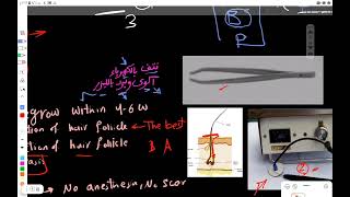 Trichiasis amp Entropion amp Ectoropion Disorders of lid lashes amp Lid margin Ophthalmology رمد [upl. by Maxantia380]