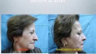 facial rejuvenation endopeel peeling de luxe by Dr Gianfranco Vettorello [upl. by Lorou]