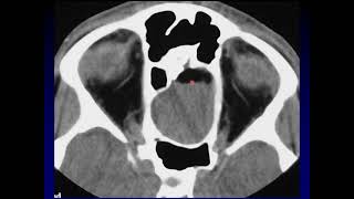 Imaging of the Paranasal Sinuses 4 [upl. by Goddord]