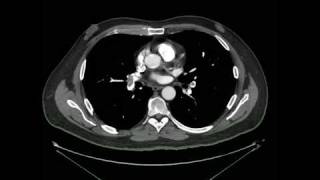 Tromboembolismo Pulmonar Angio tomografia [upl. by Nilyram]