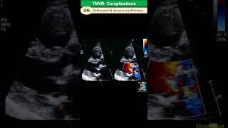 Prosthetic Valve Complications Dehiscence Paravalvular leakage Endocarditis [upl. by Karolina215]