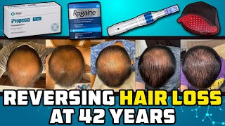 He Let Himself Go Bald Then At 42 He Tried Reversing It And This Is What Happened [upl. by Puff]