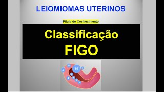 Classificação FIGO dos Leiomiomas Uterinos  Pílula de Conhecimento [upl. by Annoved]