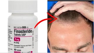 Should you MicroDose Finasteride for Hair Loss [upl. by Leuqram]