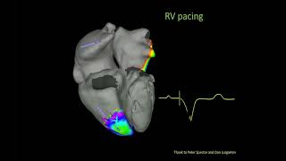 Bradycardia amp Pacing  Cardiology Board Review [upl. by Niwre]