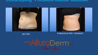 AlluraDerm CoolSculpting Before and After [upl. by Inttirb]