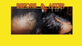 ALOPECIAHAIR LOSS HAIRSTYLE BRAID PATTERN  NO GLUE FOR WOMEN WITH FRAGILE EDGES amp SHORT HAIR [upl. by Adeirf]