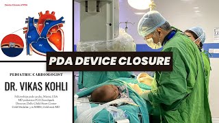 PDA DEVICE CLOSURE BY DR VIKAS KOHLI  ANGIOPLASTY  CONGENITAL HEART DEFECT CHD [upl. by Chema]