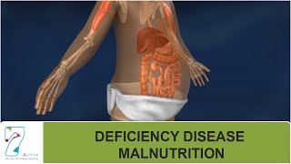 DEFICIENCY DISEASE  MALNUTRITION [upl. by Nifled]