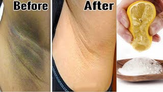 How to get rid of Underarm Darkness Home remedies and Prevention [upl. by Pacien957]