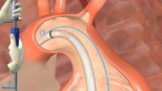 Thoracic Endovascular Aortic Aneurysm Repair in Dallas [upl. by Norrek]