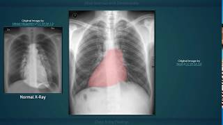 Situs Inversus with Dextrocardia Explanation of Chest Xray Findings [upl. by Lema]