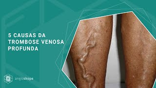 5 causas da trombose venosa profunda  Clínica Angioskope [upl. by Eeneg]